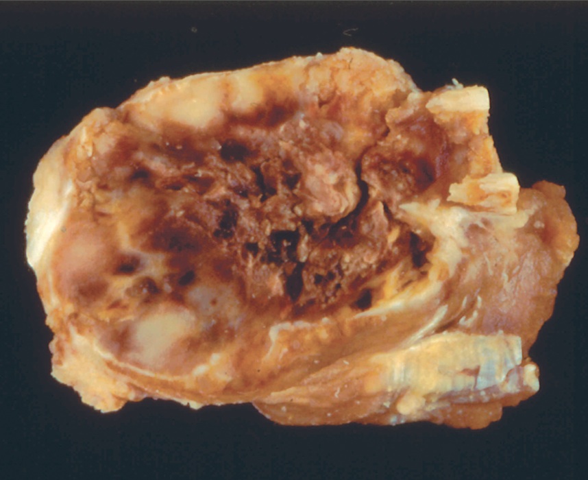 Pathology Outlines Giant Cell Tumor Of Bone